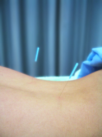 あけぼの鍼灸院　ハリ治療